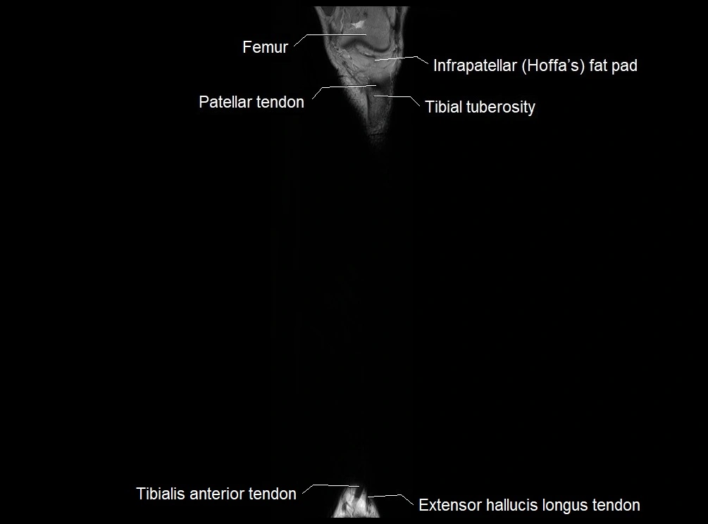 MRI 3T leg (tibia & fibula) labelled coronal cross sectional anatomy image 5.webp
